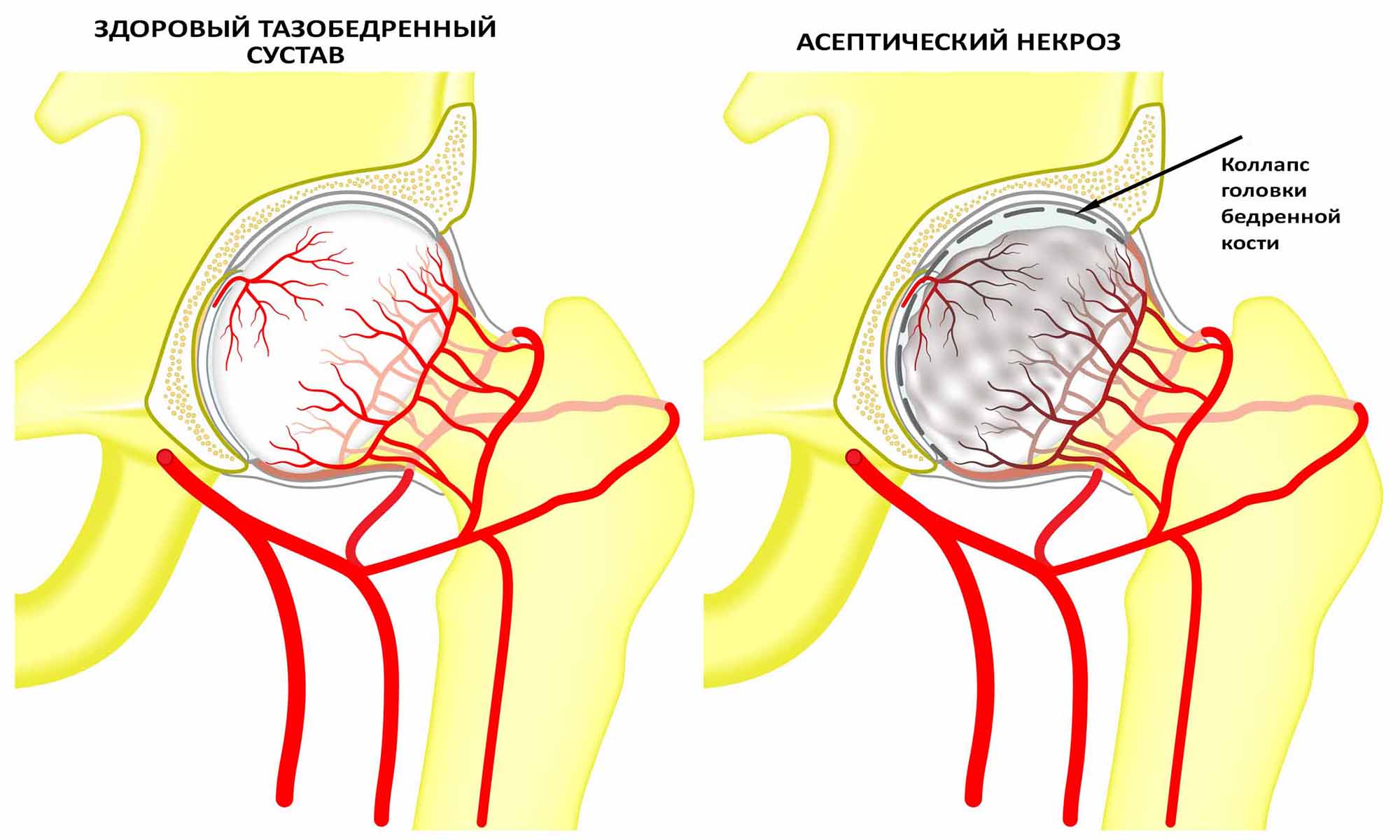 некроз головки бедренной кости